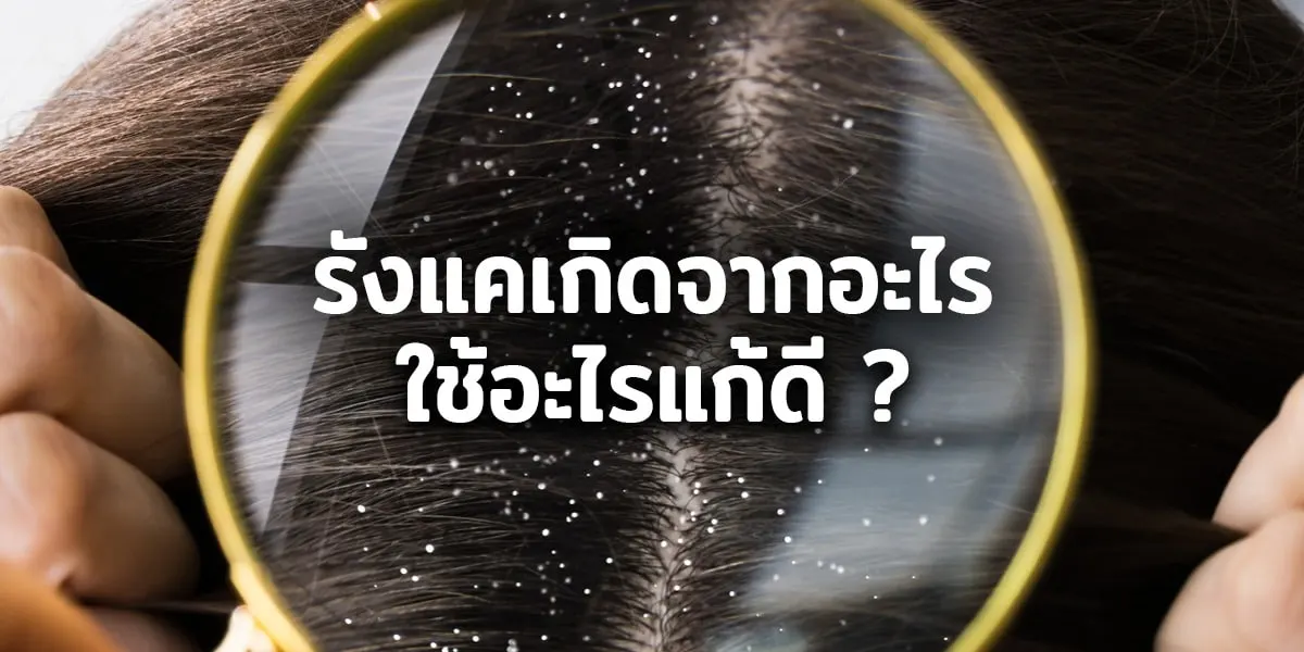 รังแคเกิดจากอะไร แก้ยังไง ใช้อะไรแก้ดี