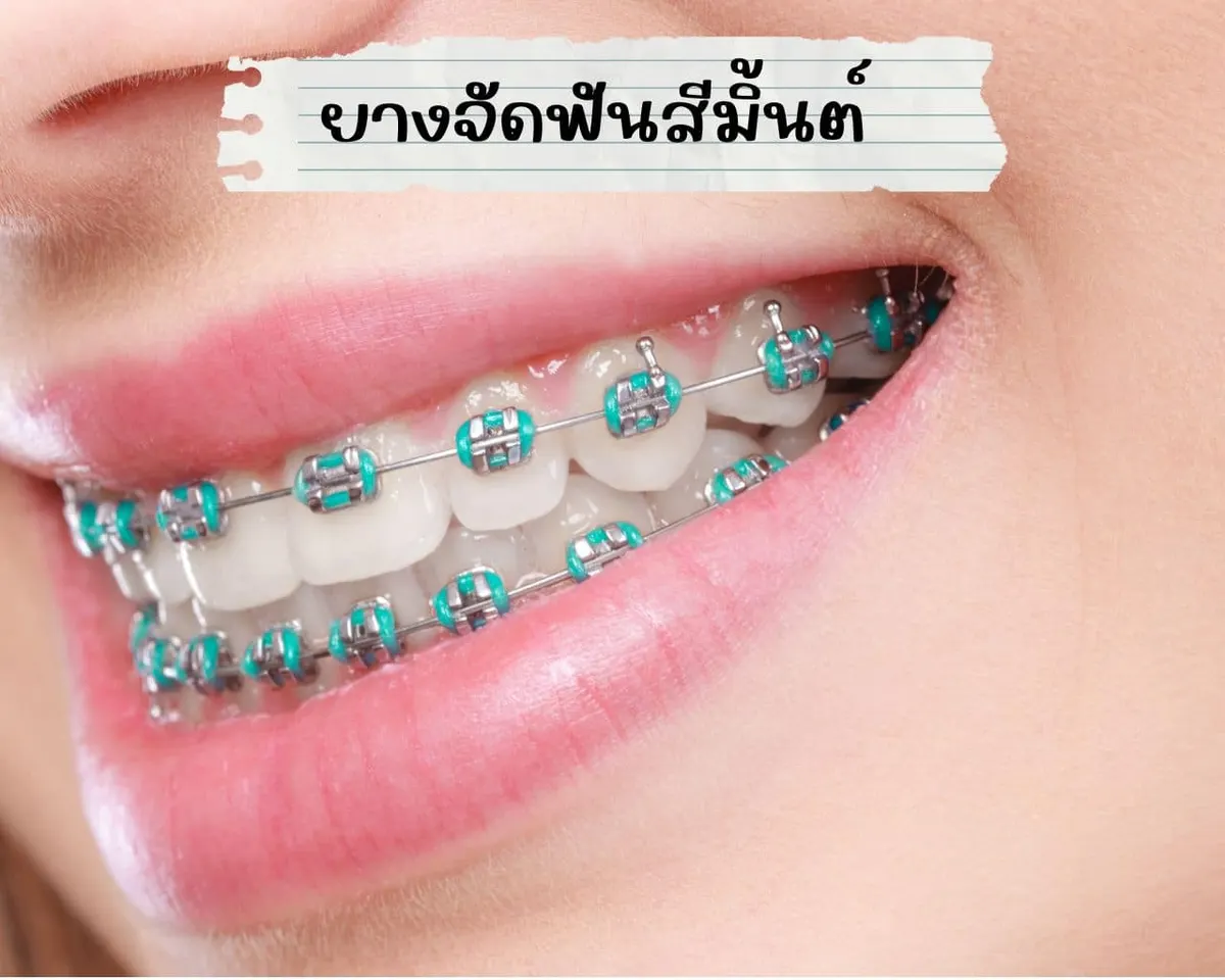 ยางจัดฟันสีมิ้นต์
