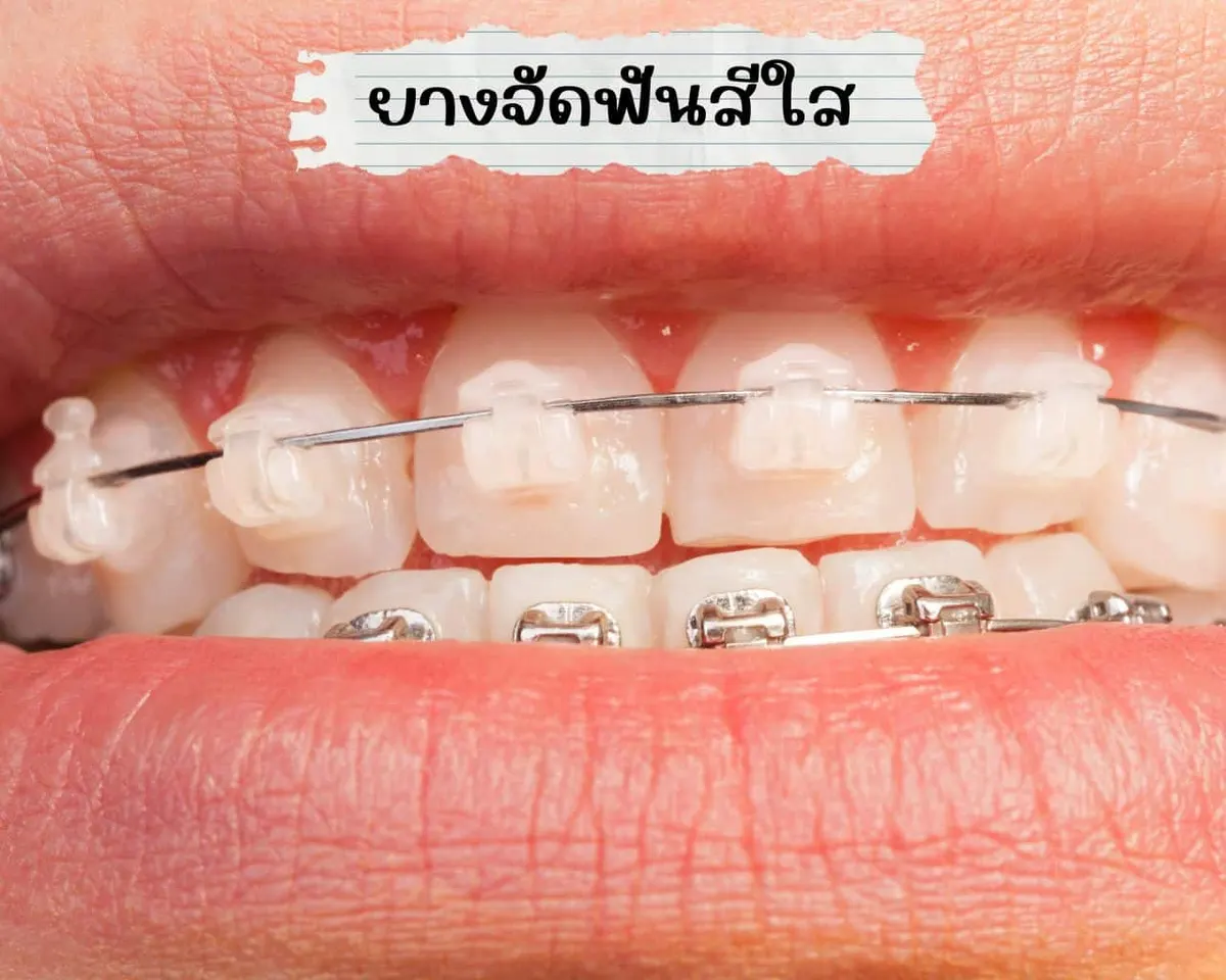 ยางจัดฟันสีใส