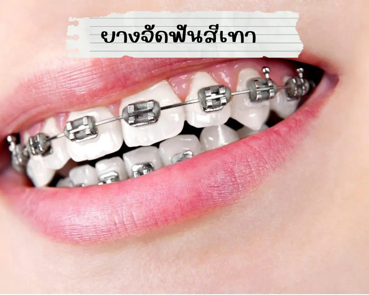 ยางจัดฟันสีเทา