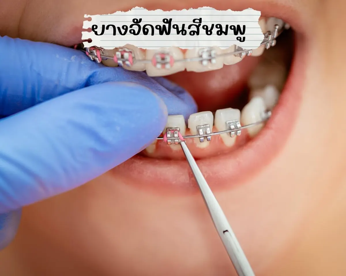 ยางจัดฟันสีชมพู