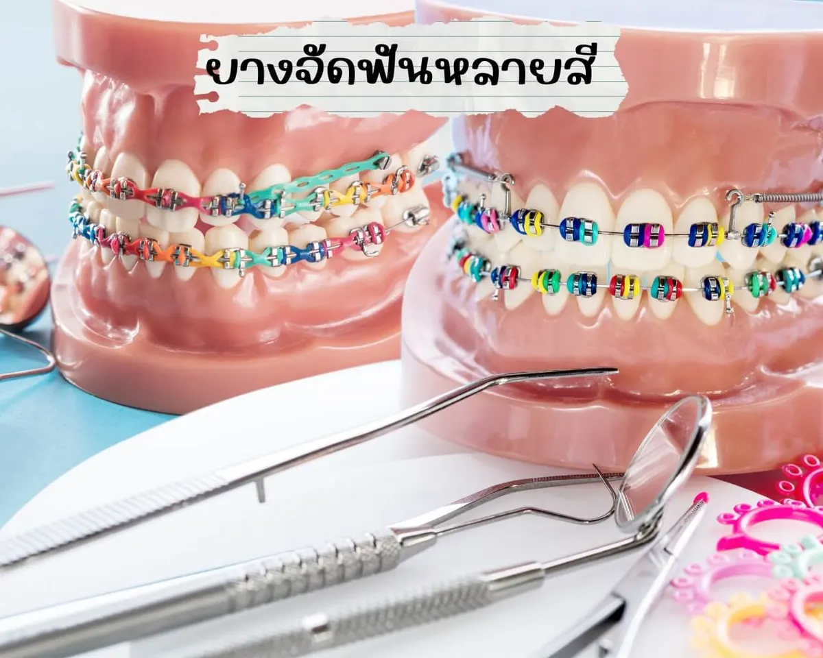 ยางจัดฟันหลายสี