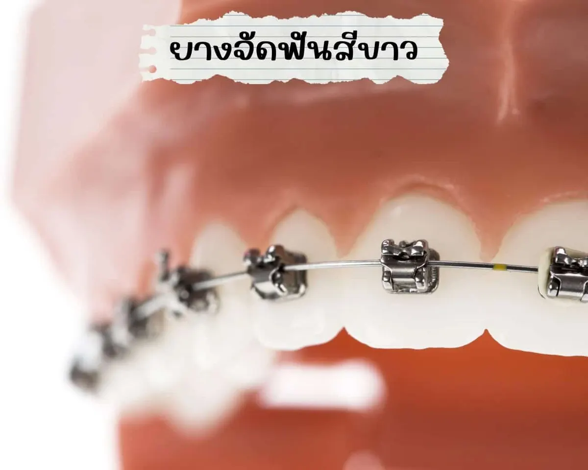 ยางจัดฟันสีขาว