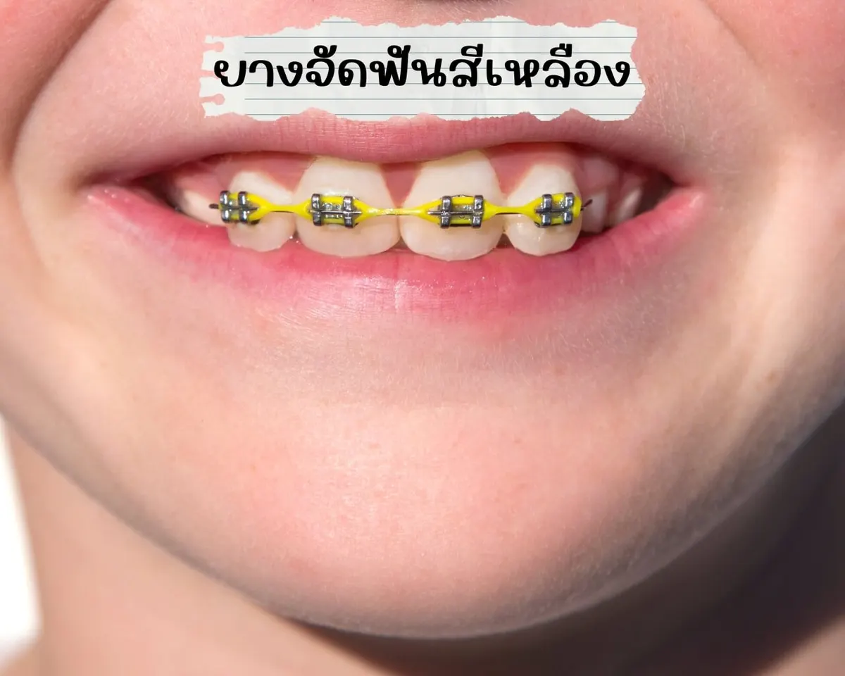 ยางจัดฟันสีเหลือง