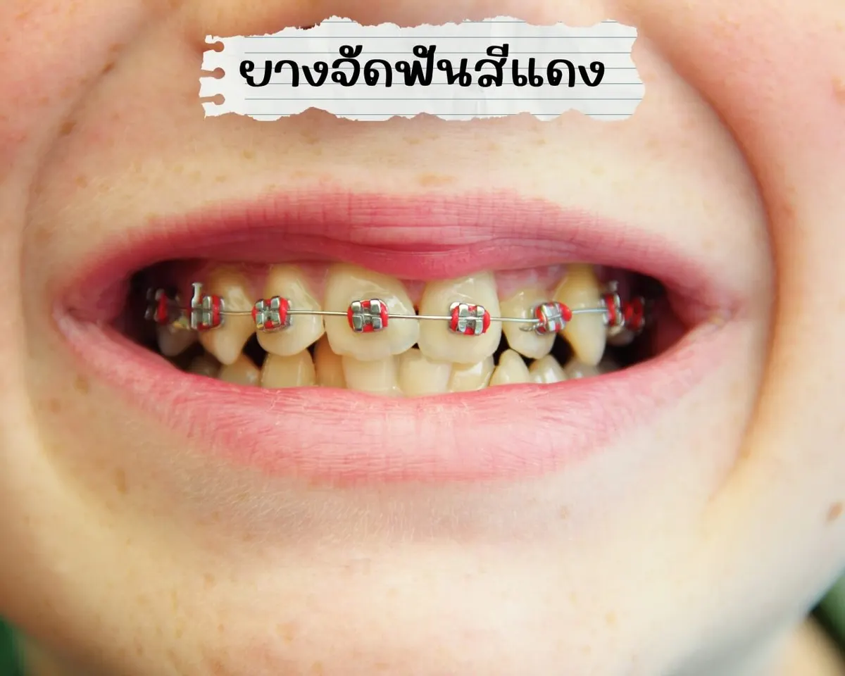 ยางจัดฟันสีแดง