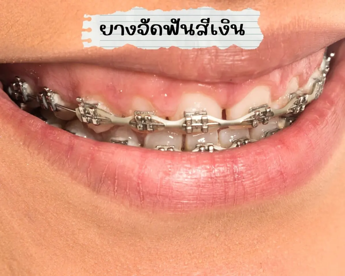 ยางจัดฟันสีเงิน